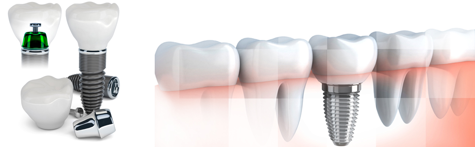 Dental Implant