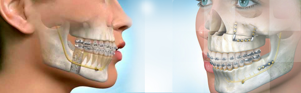 Maxillo Facial Surgery