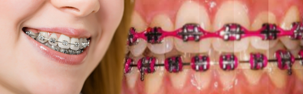 Braces