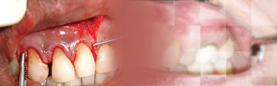 Endodontic Surgery